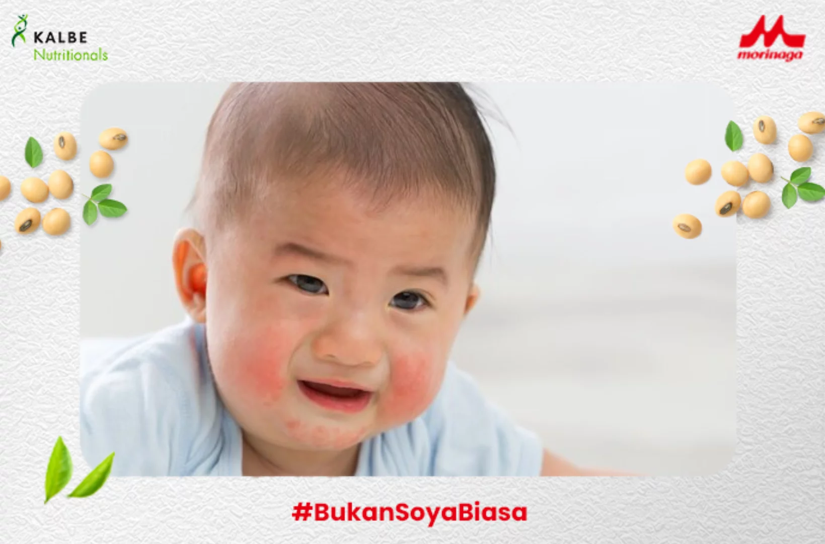 Ruam Merah pada Si Kecil