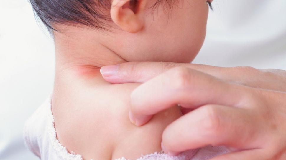 Dermatitis Atopik pada Anak: Ciri dan Penanganan