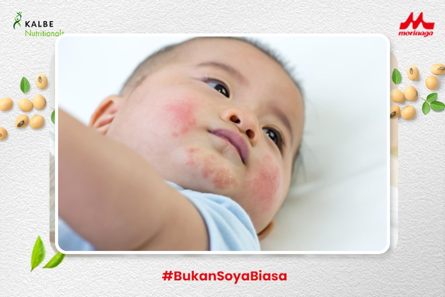gambar bintik merah alergi susu sapi