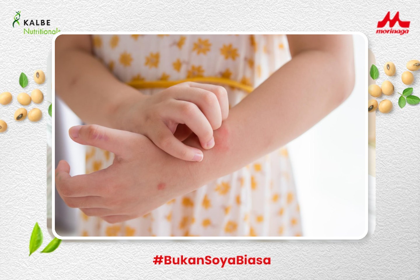 anak mengalami gatal-gatal berulang pada kulit
