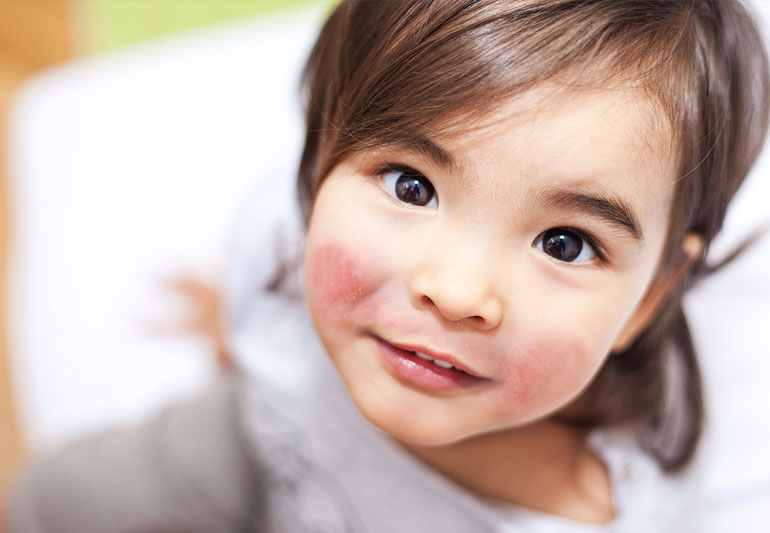 6 Jenis Alergi Kulit Pada Anak dan Cara Mengatasinya