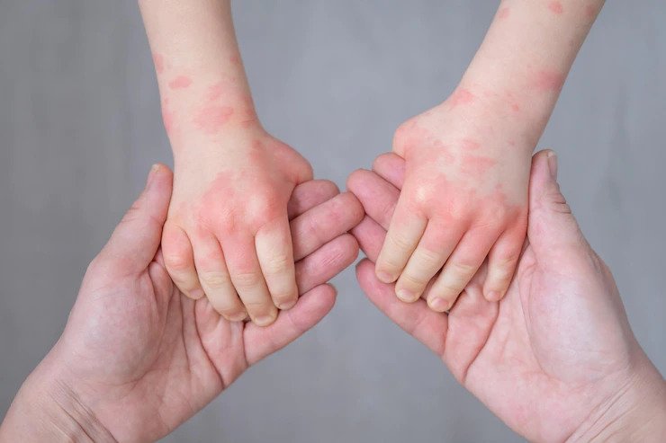 Penyebab Alergi Protein Pada Bayi dan Cara Mengatasinya 