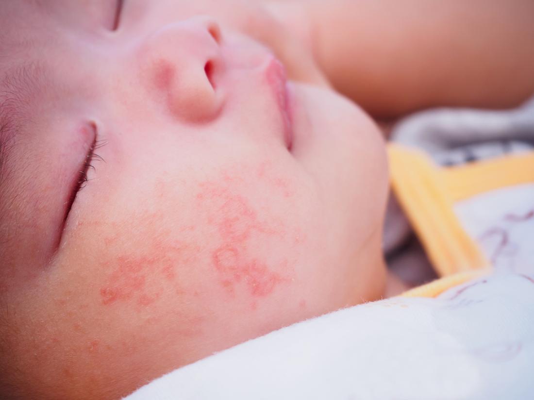 Bayi Mengalami Alergi ASI ? Mungkinkah Terjadi?