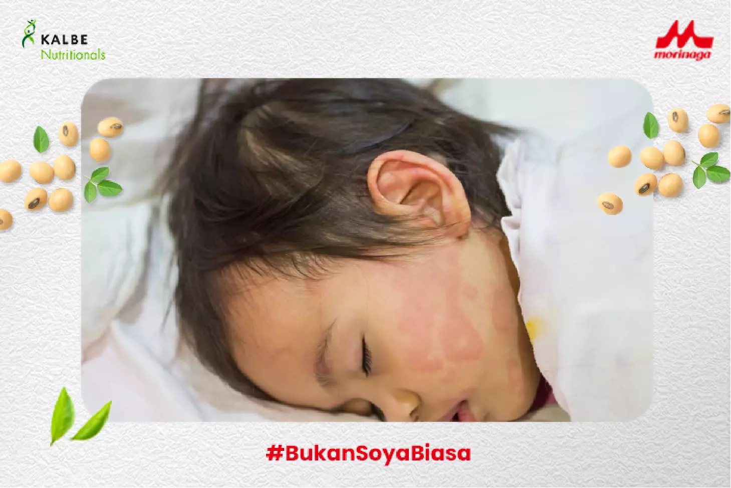 Ketahui Penyebab Biduran di Malam Hari dan Cara Mengatasinya