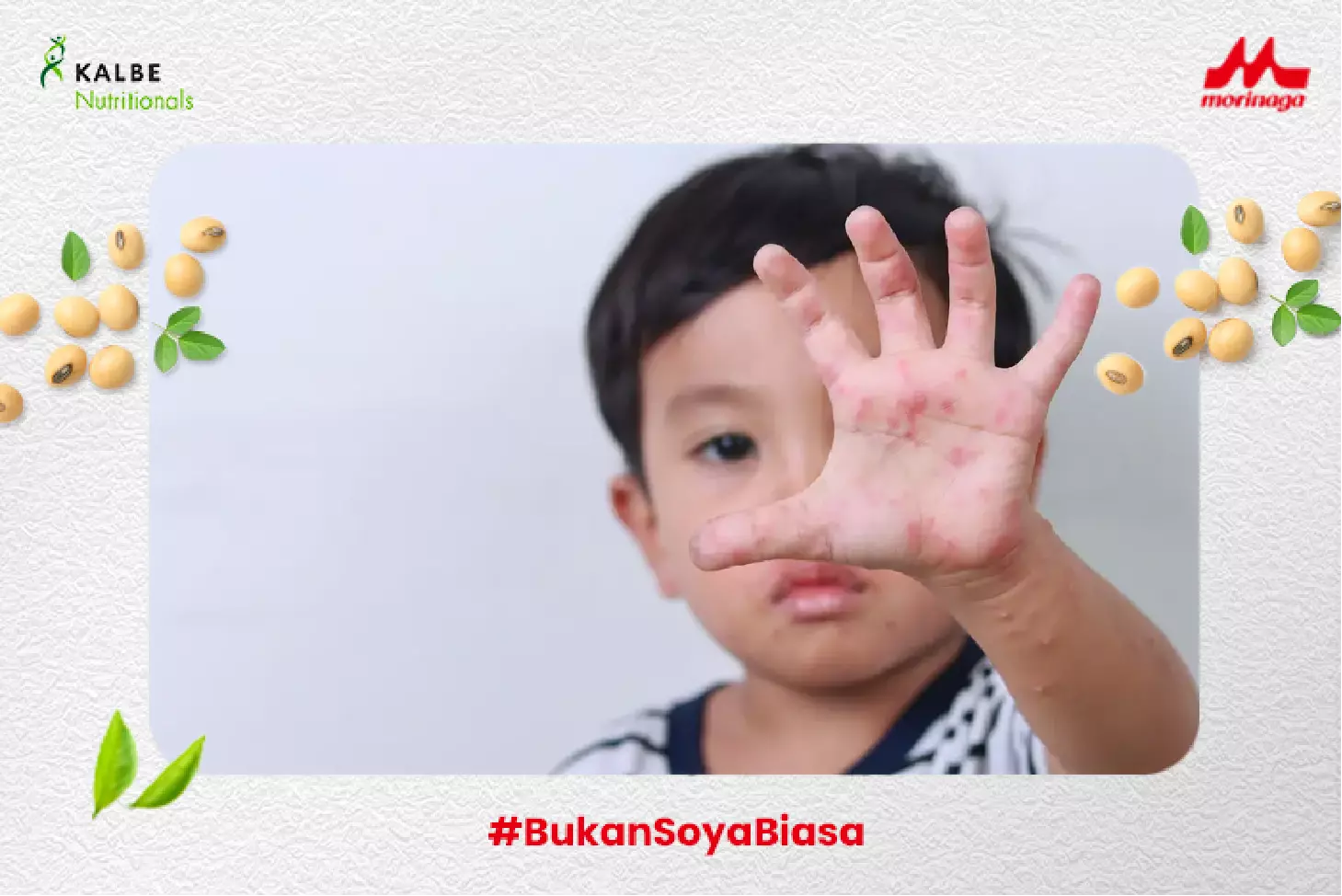 biduran tak kunjung sembuh