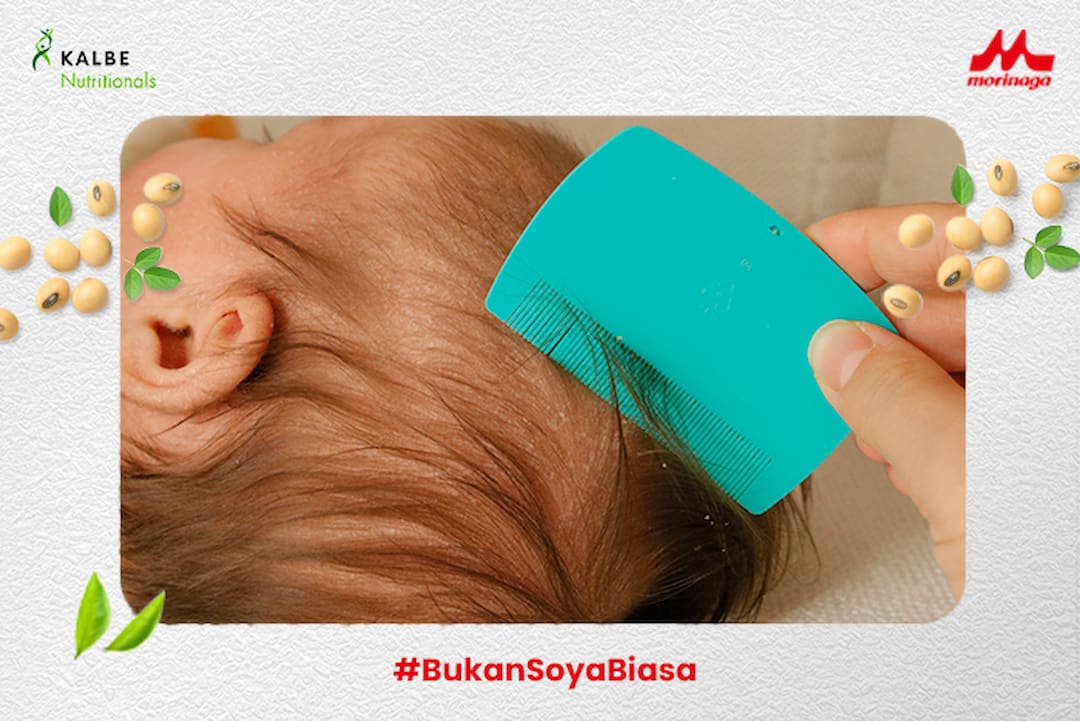 Cara Mengatasi Cradle Cap atau Kerak Kepala Bayi