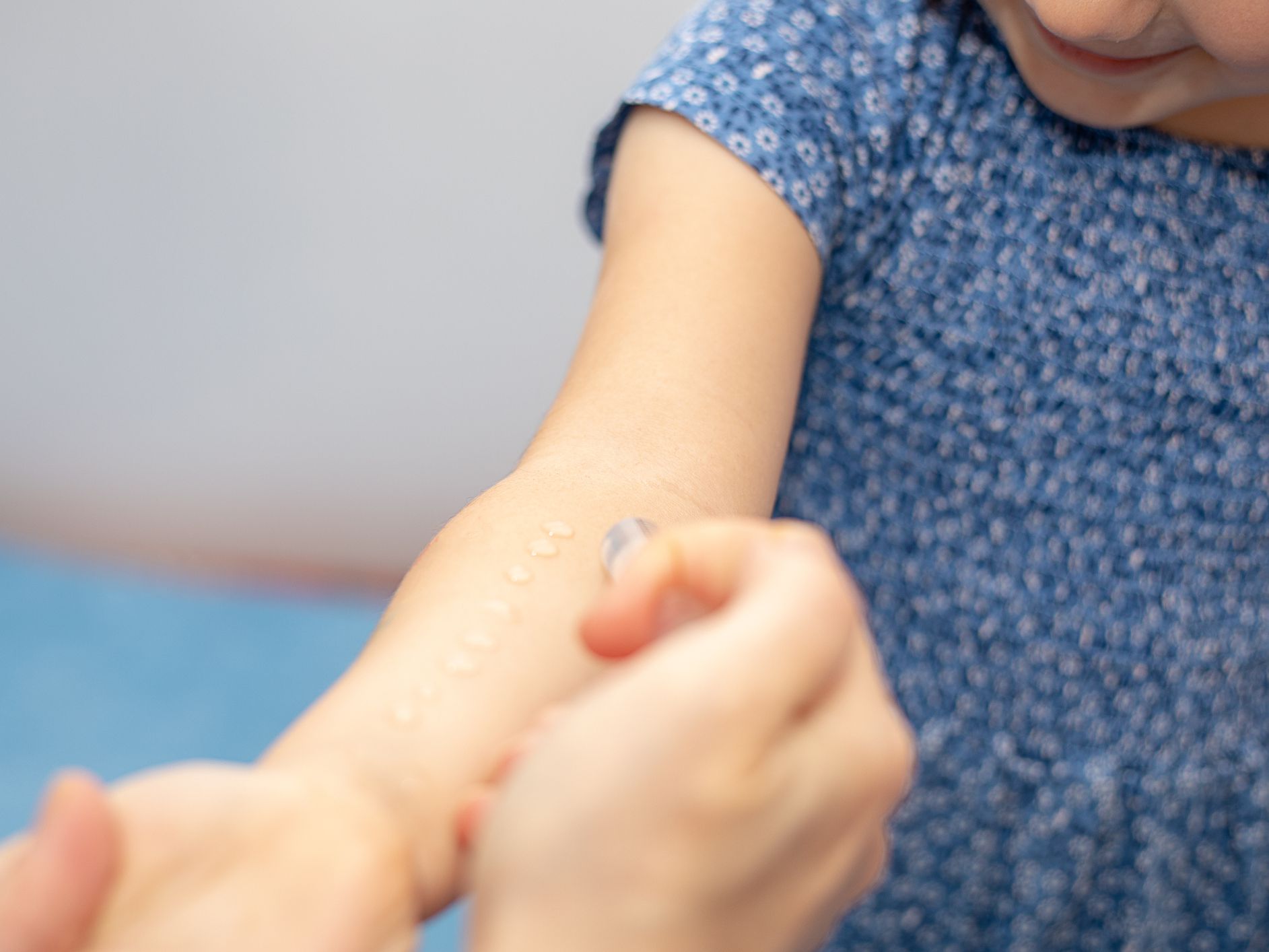 Bunda, Ini Lho 5 Jenis Alergi Kulit Pada Bayi & Anak-Anak.
