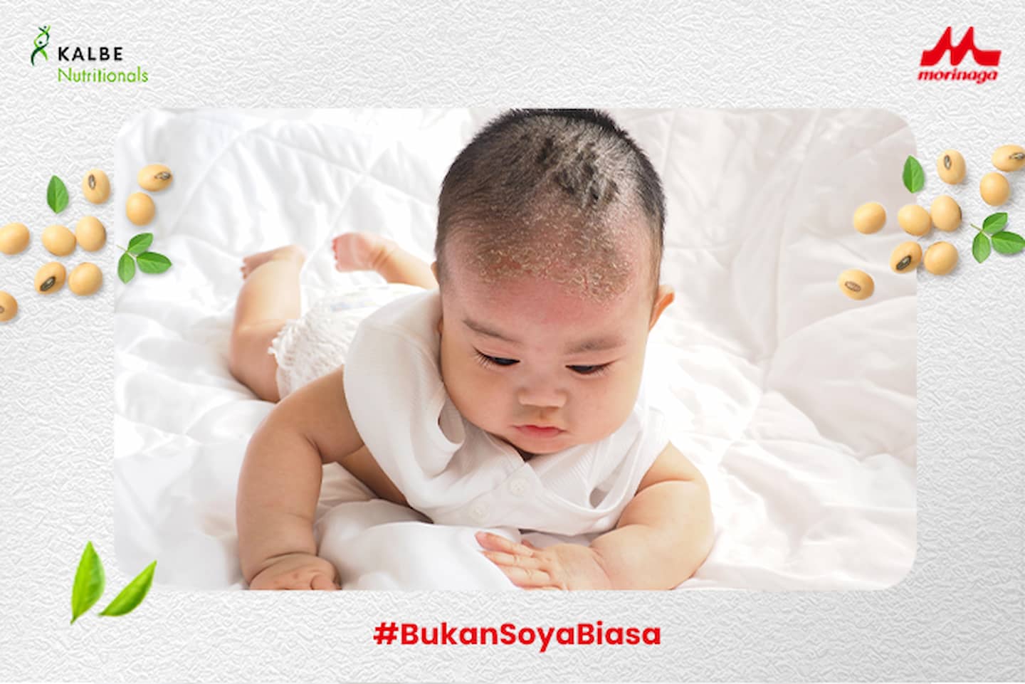 Kaitan Dermatitis Seboroik dan Alergi Susu Sapi pada Bayi