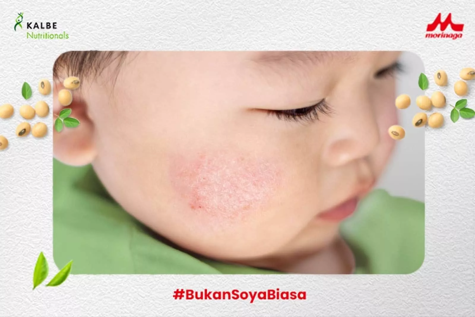 Kulit Kering dan Gatal pada Si Kecil Akibat Eksim Susu