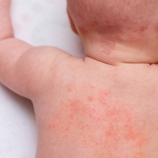9 Bintik Merah Pada Bayi dan Cara Mengatasinya