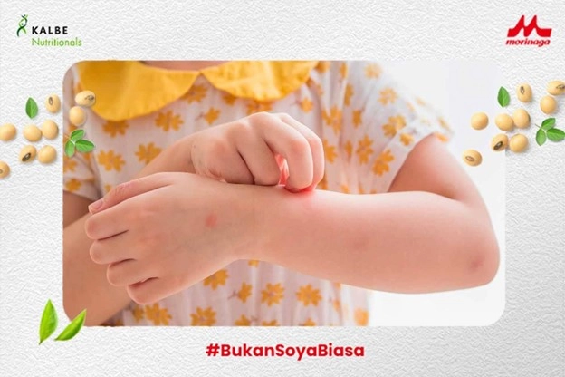 Patch Test untuk Deteksi Alergi Kulit Si Kecil Secara Akurat