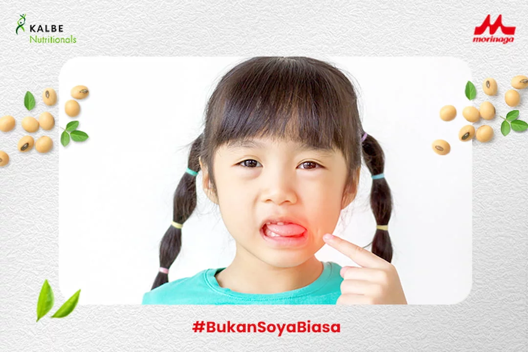 Sariawan pada Si Kecil dan Cara Mengatasinya